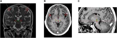 Bilateral Posterior Subthalamic Area Deep Brain Stimulation for Essential Tremor: A Case Series